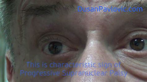 Progressive Supranuclear Palsy Youtube