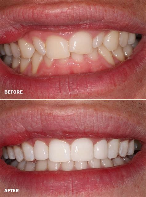 Cosmetic Bonding Chatham Teeth Bonding Dental Bonding Medway