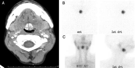 Ectopic Thyroid Gland Shown By Computed Tomography Scan A 123 Iodine