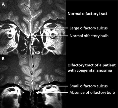 MRI coronal view of the olfactory tract of a healthy subject (A) and of ...