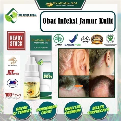 Jual Obat Infeksi Jamur Kulit Obat Gatal2 Obat Gatal Pada Kulit Obat