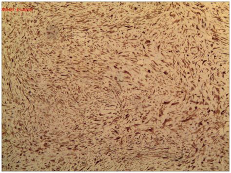 Immunohistochemical Analysis Demonstrated Diffuse Nuclear Expression Of Download Scientific