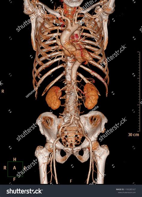 Cta Whole Aorta Ct Angiography 3d Stock Illustration 1193285167 ...