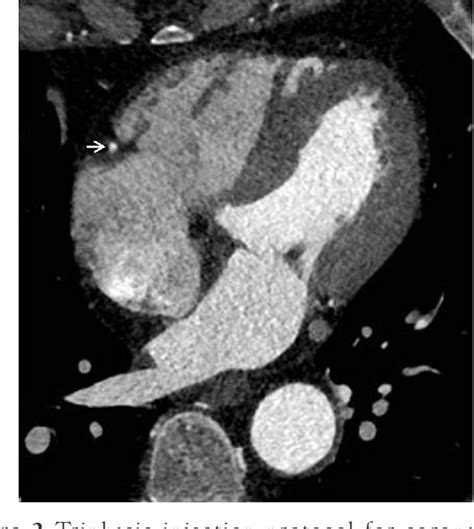 Figure 2 From Advances In Cardiac Ct Contrast Injection And Acquisition Protocols Semantic