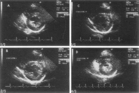 What is Stress Echocardiography?