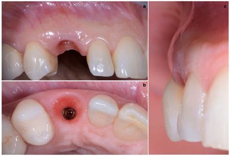 JCM Free Full Text A Novel Muco Gingival Approach For Immediate