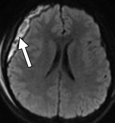 Traumatic Brain Injury Imaging Patterns And Complications Radiographics