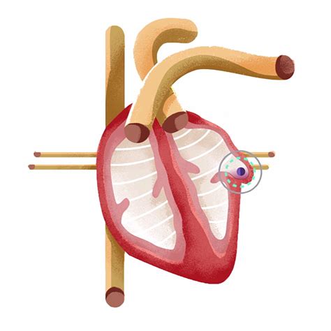 WATCHMAN Procedure • Cardiovascular Institute