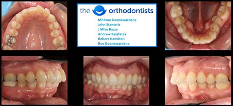 Before And After Invisalign Cases