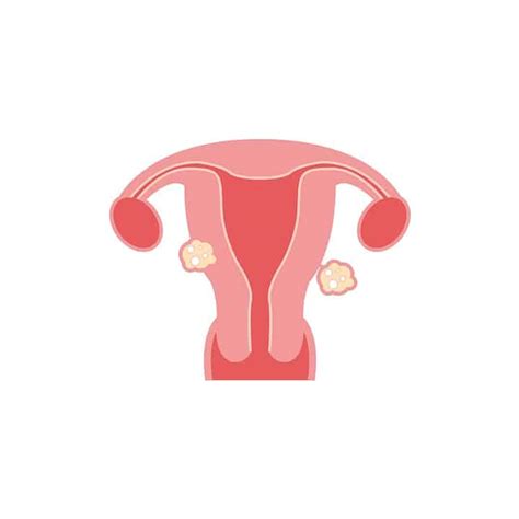 Fibroids: Causes, Symptoms, And Treatments