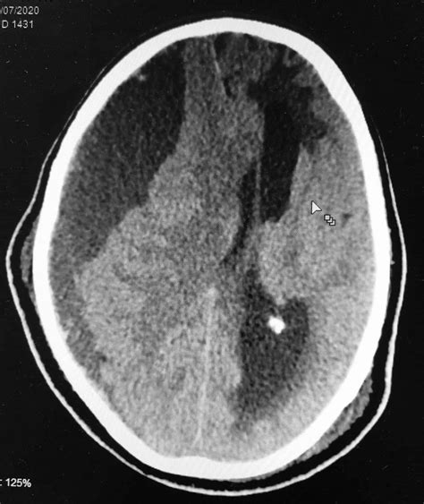 Hematoma subdural crônico Dr Antônio Prates Jr Neurocirurgião