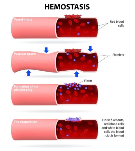 Cmi Disorders Of Hemostasis And Coagulation Flashcards Quizlet