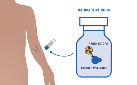 Lutetium-177 PSMA Therapy