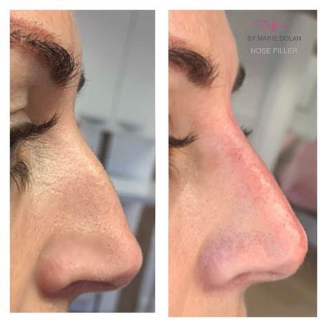 Non Surgical Rhinoplasty Nose Filler Nose Fillers Nose Nose Job