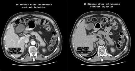 Dynamic And Delayed Contrast Enhanced Ct Scans Demonstrate A