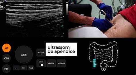 Apendicite Causas Sintomas Tratamento E Cirurgia HC Imagem