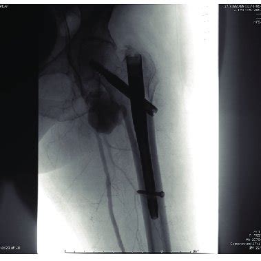 Pre-operative pelvis X-ray: Left pertrochanteric hip fracture. After ...