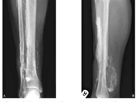 Figure From Post Traumatic Calcific Myonecrosis Of Flexor Hallucis