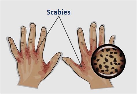 Scabies Rash On Hands