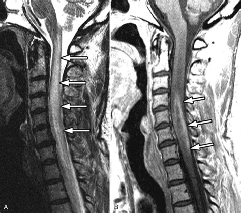 Spinal Cord Glioma Radiology Key