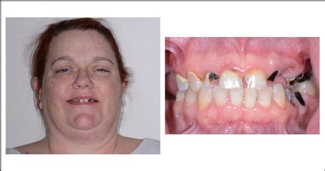 Restore Your Smile With All On X Dental Implants From Top Specialized