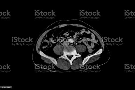 Computer Tomography Angiography Cta Of Whole Body Scan With 3d Reconstruction Ct Angiography For