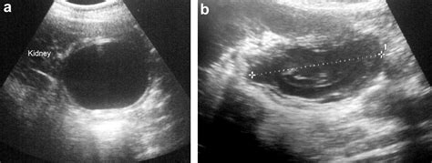 Retroperitoneal Laparoscopic Approach For Renal Hydatid Cyst In