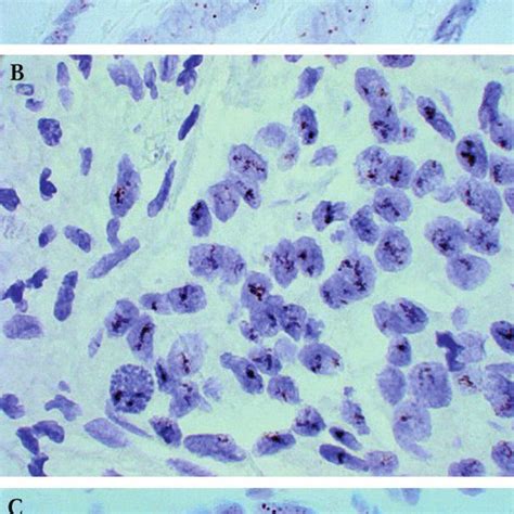 Examples Of Her2 Detection Using The Chromogenic In Situ Hybridisation