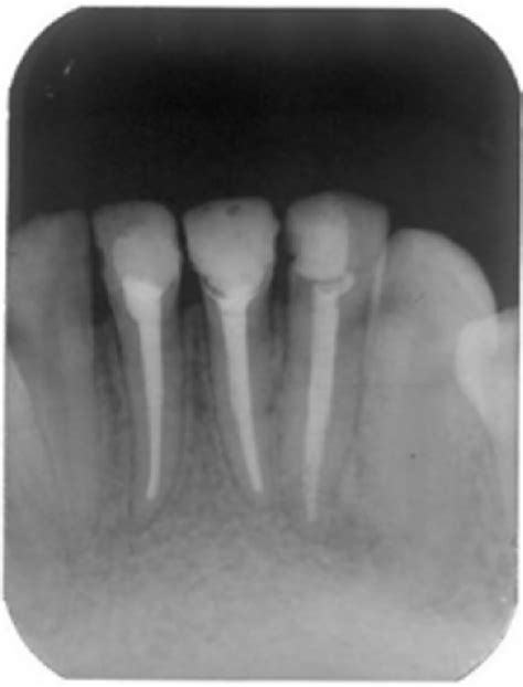 Figure 1 From Single And Multiple Session Endodontic Treatment Of Teeth With Periapical Diseases