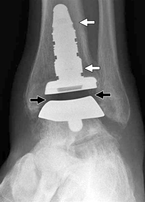 Current Concepts In Total Ankle Replacement For Radiologists Features