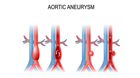 Aort Anevrizması Nedir Koru Hastaneleri