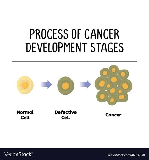 Process of cancer development stages isolated Vector Image