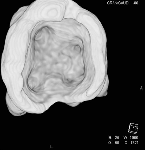 Morphological features of five-rooted maxillary second molar evaluated