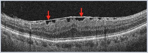 Epiretinal Membrane Oct