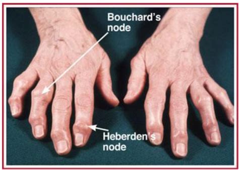 Msk Disorders Flashcards Quizlet