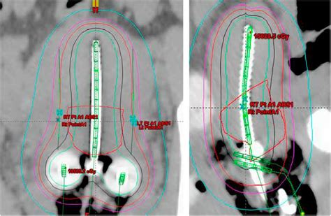 Dosimetric evaluation of tandem-based cervical high-dose-rate ...