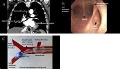 SciELO Brasil Tracheal Bronchus Implications For Lung Isolation