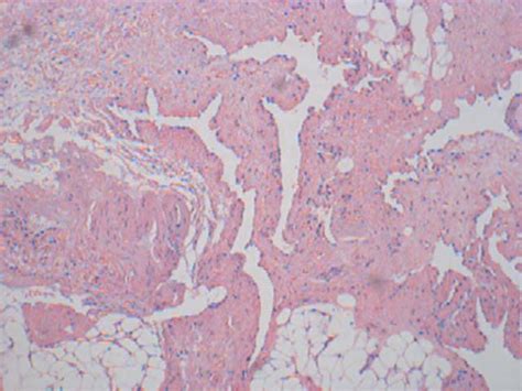 Lymphangioma Histology