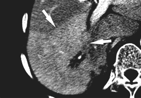 Relationship Between Various Patterns Of Transient Increased Hepatic