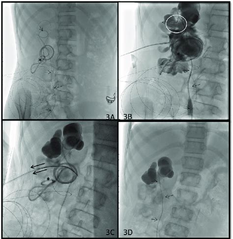 Fluoroscopic Spot Image A Of The Kub Region Shows Coiled Up Migrated