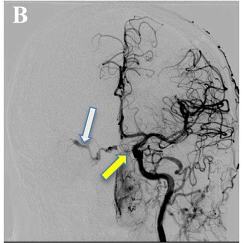 A Dsa Of The Right Internal Carotid Artery Ica In Lateral