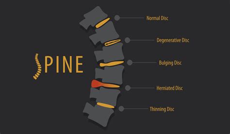 The Most Common Back Surgeries Explained Comprehensive Orthopaedics