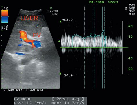 Right And Left Portal Vein Ultrasound