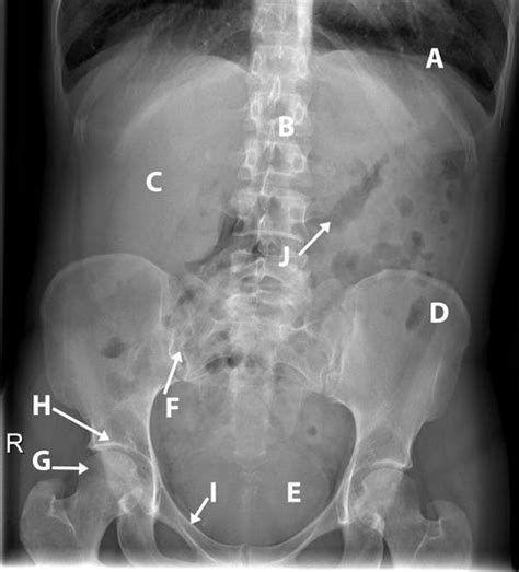 Interpreting Abdominal Radiographs The Bmj