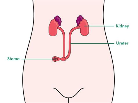 Urostomy Ileal Conduit The Australian Council Of Stoma Associations Inc