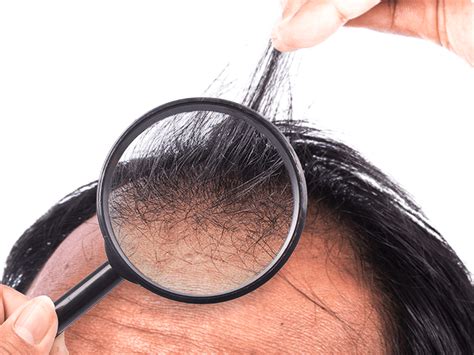 Alopecia Areata Cause E Possibili Rimedi Istituto Helvetico Sanders