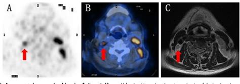 Figure 1 From Advantage Of PET CT In Target Delineation Of MRI Negative