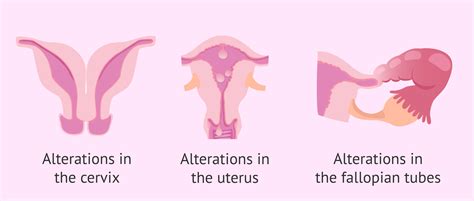 What Is Hysterosalpingography Hsg Why And How Is It Performed