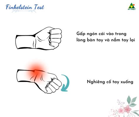 CÁCH NHẬN BIẾT BỆNH LÝ VIÊM MỎM TRÂM QUAY HỘI CHỨNG DEQUERVAIN