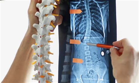 Spinal Fusion For Atlanta Ga Max Steuer Md Neurosurgeons And Spine